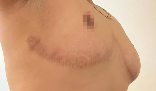 جراحی ماستکتومی