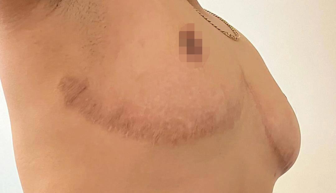 جراحی ماستکتومی