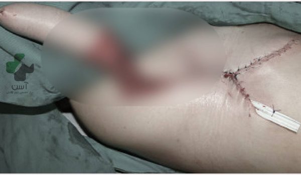 فالوپلاستی